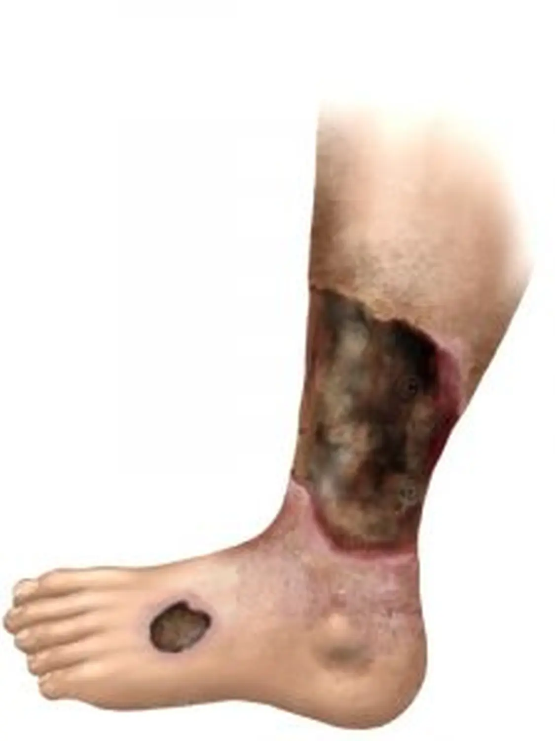 AgoCare UG - Gesundheitsdienstleister - Arterielle Verschlusskrankheit (PAVK) von AgoCare UG (Haftungsbeschränkt)