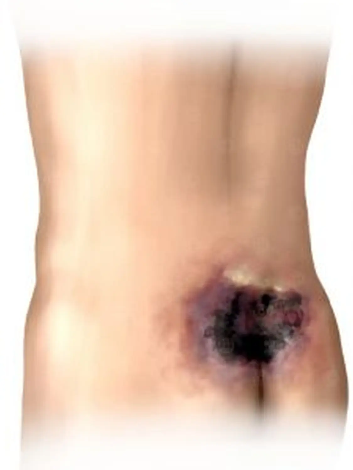 AgoCare UG - Gesundheitsdienstleister - Dekubitus von AgoCare UG (Haftungsbeschränkt)