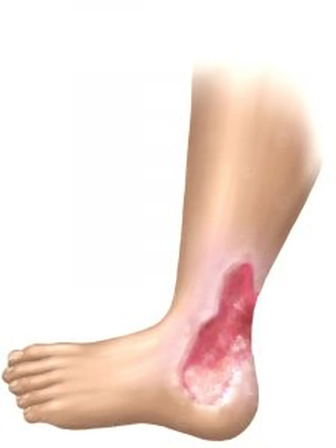 AgoCare UG - Gesundheitsdienstleister - Ulcus Cruris Venosum von AgoCare UG (Haftungsbeschränkt)